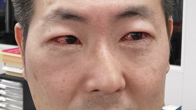 「何もできん」まぶた腫れ、大量の目やに…“はやり目”で社会生活が完全停止した　原因はプール熱と同じウイルス、24時間以上も生存|TBS NEWS DIG