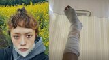 広田レオナさん 「足首骨折してるみたい」 痛々しい足の写真をアップ 「痛すぎて動けないから救急車呼んで...」「とほほ~」|TBS NEWS DIG