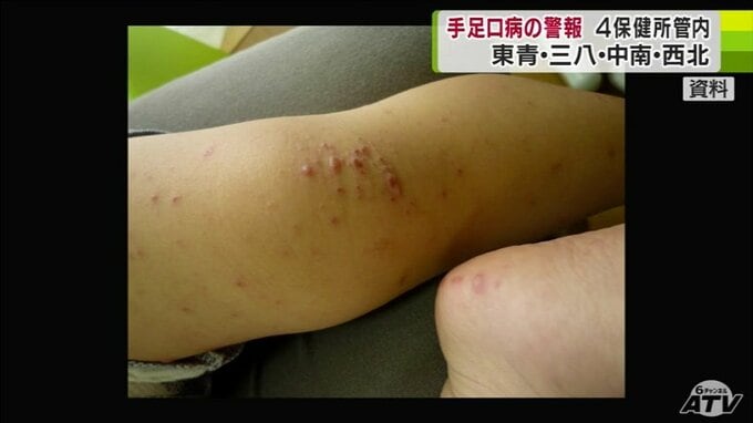 「ひざから下、手から指先、体中に出る子が多い」感染症「手足口病」の感染拡大　青森県内の4つの管内に警報発表　|　青森のニュース│ATV NEWS│青森テレビ