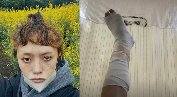 広田レオナさん　「足首骨折してるみたい」　痛々しい足の写真をアップ　「痛すぎて動けないから救急車呼んで...」「とほほ～」|TBS NEWS DIG