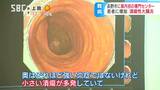 安倍元総理も患った「潰瘍性大腸炎」自分の意思に関係なく便意が…若者中心に毎年1万人ずつ増えているとも言われる難病の高校3年生が出会ったのは…?潰瘍性大腸炎とクローン病に特化した最新施設の治療 | SBC NEWS | 長野のニュース | SBC信越放送