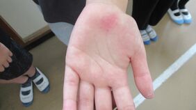 プール授業で児童25人が”手に湿疹としびれ”　原因はプールサイドに手をついたことによる圧迫痕の可能性　北九州市教委が会見|TBS NEWS DIG