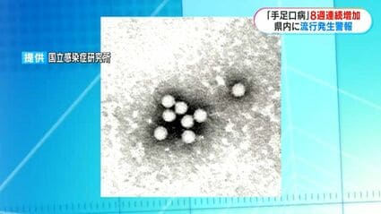 手足口病の感染者8週連続で増加 先週から県内全域に流行発生警報