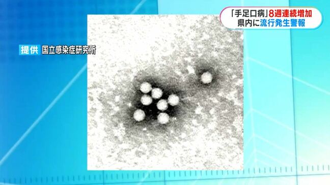 手足口病の感染者8週連続で増加　先週から県内全域に流行発生警報　鹿児島県|TBS NEWS DIG