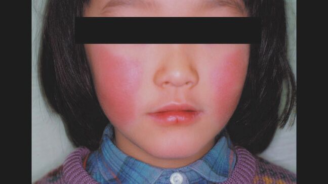 「リンゴ病」感染拡大　大分県全域に6年ぶり警報|TBS NEWS DIG