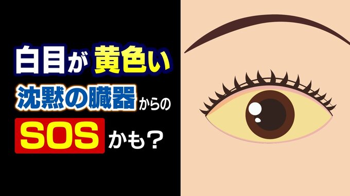 「白目が黄色い」は “沈黙の臓器” からのSOSかも 放置は厳禁 専門医が教える病気のサインと日常生活に潜む要因　|　富山のニュース｜天気・防災｜チューリップテレビ