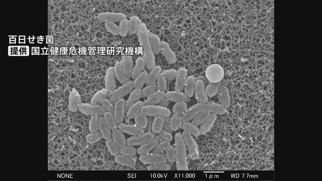 百日咳が県内で過去最多　小学校高学年から中学生を中心に拡大　県は早期の医療機関受診を呼びかけ　富山|TBS NEWS DIG