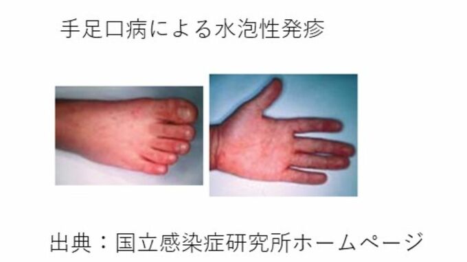 幼稚園で「手足口病」による学級閉鎖「手足口病が増えている」県が注意を呼びかけ【岡山・倉敷市】　|　岡山・香川のニュース | 天気 | RSK山陽放送