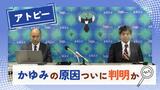 アトピーの「かゆみ原因」+「改善法」がつきとめられる、佐賀大学が治療薬の開発へ | 福岡のニュース|RKB NEWS|RKB毎日放送