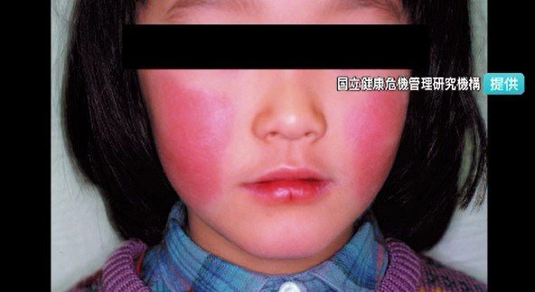 「百日咳」と「りんご病」　長野県内の患者数は減少　依然として例年より高水準続く|TBS NEWS DIG