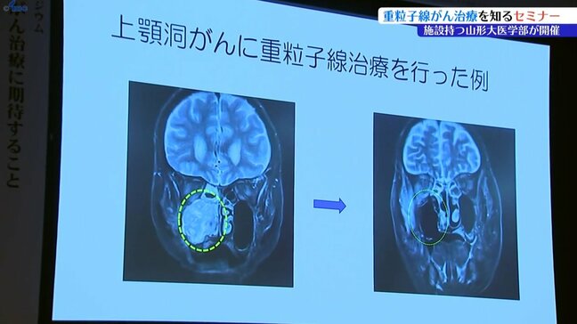 放射線治療の一種、重粒子線がん治療について知るセミナー 盛岡市|TBS NEWS DIG