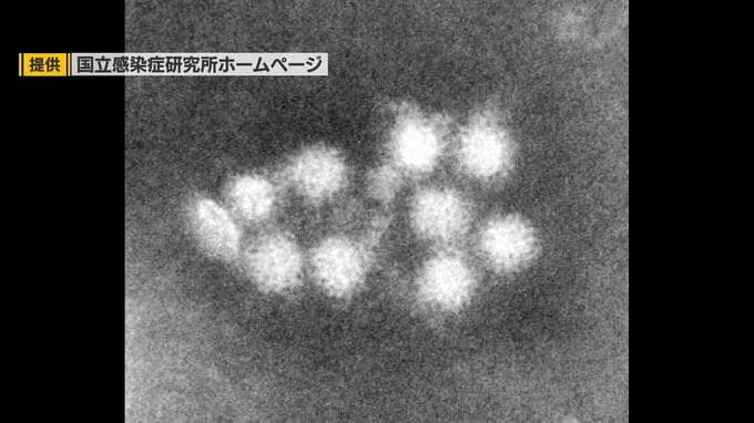 「アルコールが効くわけではない」病院内で76人が下痢や嘔吐…　集団発生の『感染性胃腸炎』　保健所の検査で『ノロウイルス検出』　消毒方法の注意点は？専門家に聞いてみた|TBS NEWS DIG