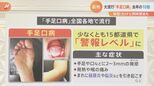 すでに“警報レベル！”全国各地で、子どもたちが感染する「手足口病」。 患者数は去年の10倍！新型コロナと同時に感染も…|TBS NEWS DIG