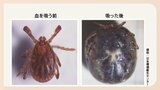 ６０代女性マダニに噛まれ入院　致命率約３０％の危険　春から秋にかけて活動活発に　|　福岡のニュース｜RKB NEWS｜RKB毎日放送