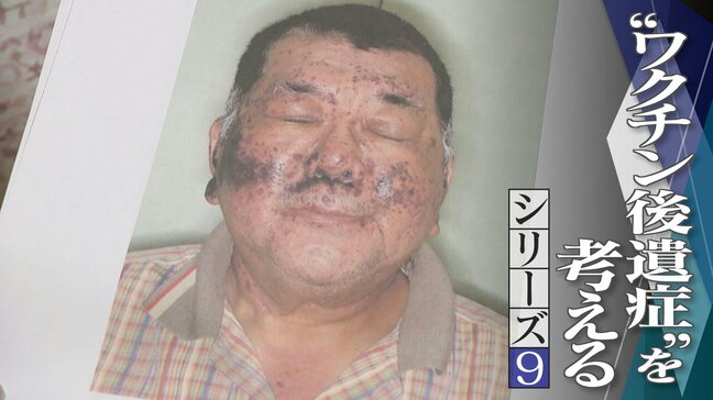 顔中に赤黒い内出血が… 手足も膨れ上がる 新型コロナワクチン接種後に夫が難病を発症し死亡 ｢検証されないと無駄死に」【“ワクチン後遺症”を考える シリーズ9】|TBS NEWS DIG