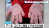宮城県内の手足口病感染者数 定点医療機関1か所あたり8.29人と前の週より増加 先週から引き続き警報レベル | 宮城のニュース│tbc NEWS│tbc東北放送