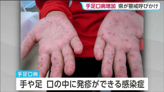 宮城県内の手足口病感染者数 定点医療機関1か所あたり8.29人と前の週より増加 先週から引き続き警報レベル|TBS NEWS DIG