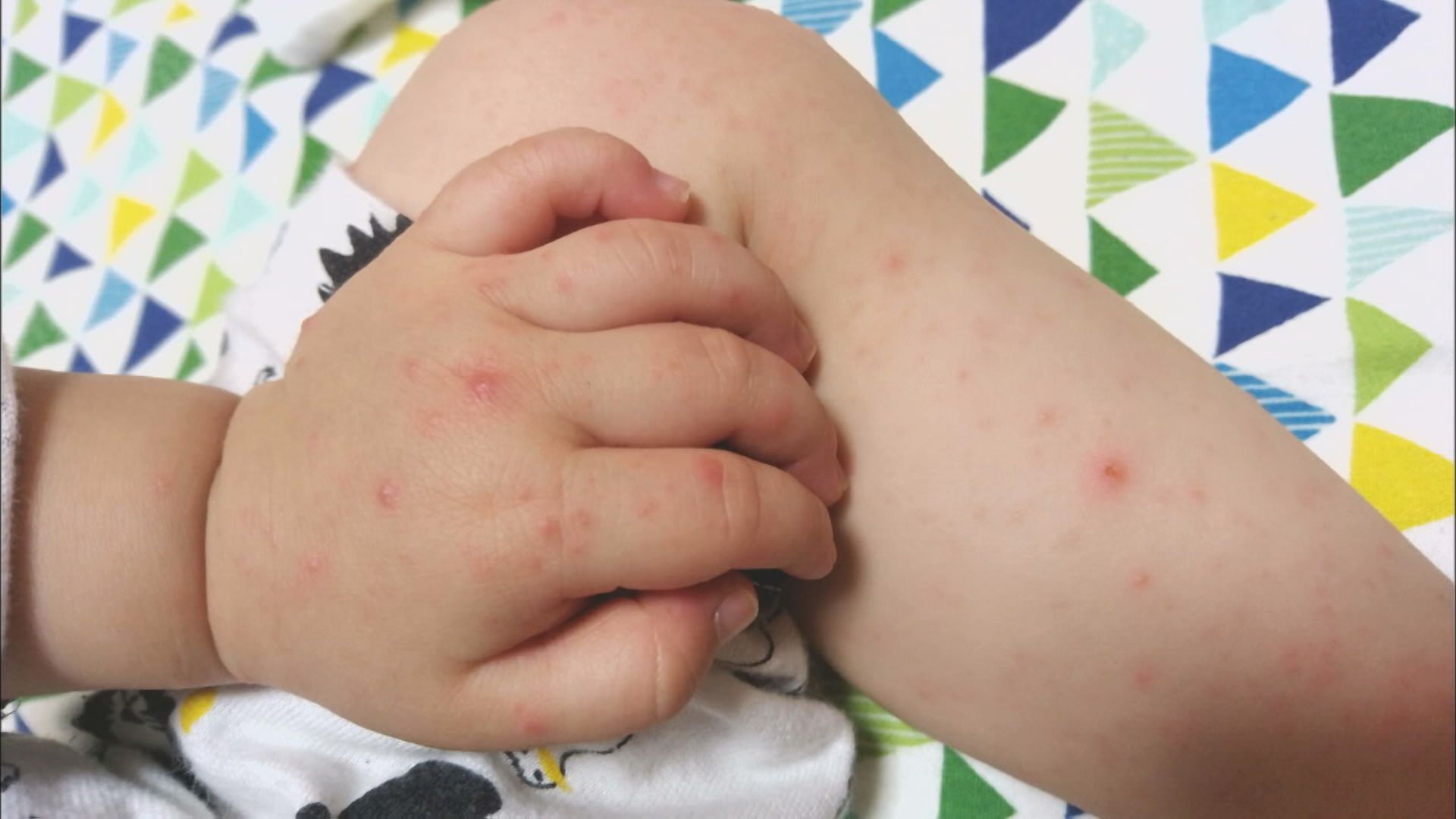 急性ウイルス性感染症の「手足口病」が流行　県が2年8か月ぶりに “警報” 発表　大分