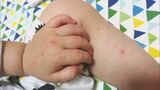 急性ウイルス性感染症の「手足口病」が流行 県が2年8か月ぶりに “警報” 発表 大分 | 大分のニュース|OBS NEWS|大分放送