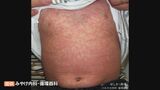 はしか感染者、全国で相次ぐ　ワクチン接種1回で大丈夫…？「抗体検査」の希望者が増加　|　BSSニュース | BSS山陰放送