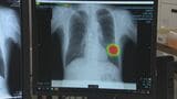 肺がん検診など胸部Ｘ線診断に「ＡＩ」導入　検診分野では中四国初　|　BSSニュース | BSS山陰放送