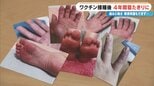 「油に足を突っ込んでいる感じ」 新型コロナワクチン接種後 4年間寝たきりに 止まらない“痛みと熱さ” 救済申請もできず… 後遺症に苦しむ患者たち|TBS NEWS DIG