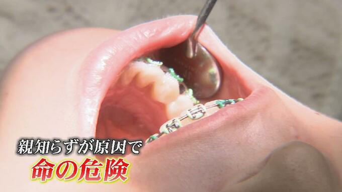 抜く？抜かない？“親知らず” 放っておくと命の危険も…一方、抜いたら神経麻痺も…専門家に聞く分かれ目は|TBS NEWS DIG