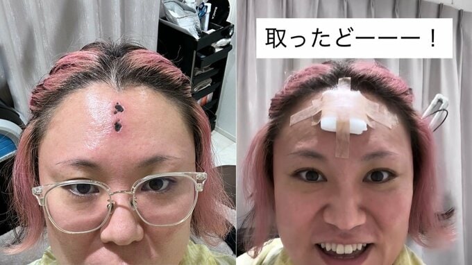 【 バービー 】額のかさぶたを手術で「取ったどーーー！」　 “みんなの心配　胸に沁みたよ” フォロワーの声に感謝|TBS NEWS DIG