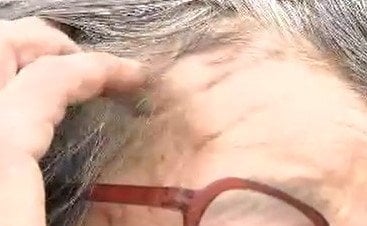 「一瞬だめかと思った」畑でクマ2頭と鉢合わせ　78歳の女性が当時の状況を語る「もう逃げるのいっぱいで」頭や顔、右腕などに深い傷　長野　|　SBC NEWS | 長野のニュース | SBC信越放送