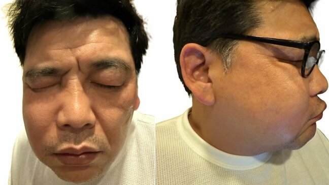 【富澤たけし】 「副鼻腔炎で顔が腫れて」 パンパンの顔をブログに掲載 “ぶん殴られた?” ファンも驚き|TBS NEWS DIG