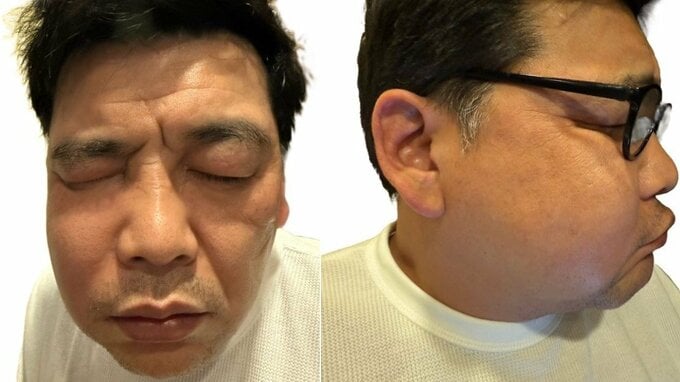 【富澤たけし】　「副鼻腔炎で顔が腫れて」　パンパンの顔をブログに掲載 　“ぶん殴られた？” 　ファンも驚き|TBS NEWS DIG