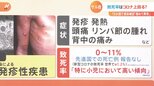 特効薬なし…欧米中心に「サル痘」が急拡大 回復後に痕が残るケースも 予防策を医師に聞く|TBS NEWS DIG