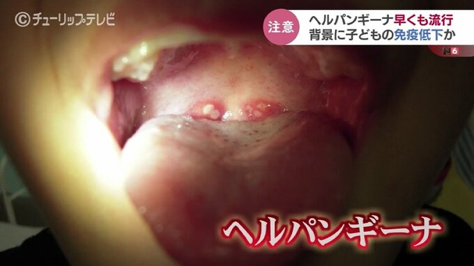 子どもの免疫低下でかかりやすく　ヘルパンギーナ早くも流行　かぜのような発熱やのどの痛み　富山　|　富山のニュース｜天気・防災｜チューリップテレビ