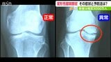 「痛い つらい」高齢女性に多い『変形性膝関節症』専門医が教える簡単チェックと予防法 | 新潟のニュース・天気|BSN NEWS|BSN新潟放送