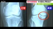 「痛い つらい」高齢女性に多い『変形性膝関節症』専門医が教える簡単チェックと予防法　|　新潟のニュース・天気｜BSN NEWS｜BSN新潟放送
