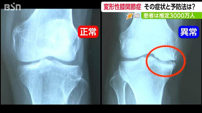 「痛い つらい」高齢女性に多い『変形性膝関節症』専門医が教える簡単チェックと予防法|TBS NEWS DIG