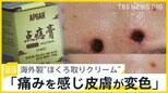 「安全かつ効果的にホクロ除去」を謳う海外製“ほくろ取りクリーム”で皮膚が変色…国民生活センターは使用中止呼びかけ【news23】|TBS NEWS DIG