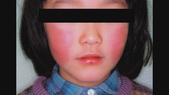 リンゴ病患者数が前週から約3倍に　妊婦が感染すると流産の危険性　3地点で警報基準に　大分|TBS NEWS DIG