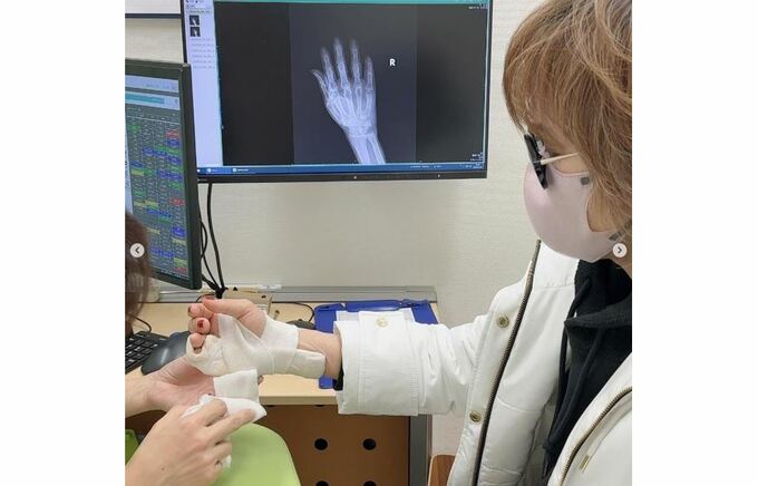小柳ルミ子さん　骨折右手指　治療の現状を報告　「ようやく骨がくっつき始め」「リハビリを痛みと戦いながら　頑張ってます」|TBS NEWS DIG