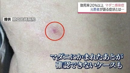命、取られたな」致死率2割超 全国で増加傾向のマダニ感染症「SFTS