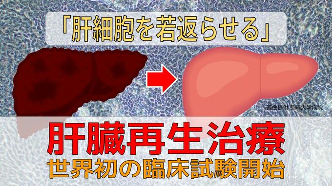 肝移植に代わる新たな選択肢に？「肝細胞を若返らせる」肝臓再生治療で世界初の臨床試験開始【長崎大学病院】|TBS NEWS DIG