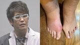 【 古坂大魔王 】痛風で「風が吹かなくてもいてーよ！」　右脚が腫れて「痛無風だよ！」|TBS NEWS DIG
