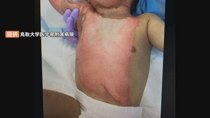 全身の皮膚の40％に重いやけど　２歳未満男児の救命に成功　自家培養表皮・人工真皮を使い国内初の治療例　鳥取大学医学部附属病院　|　BSSニュース | BSS山陰放送
