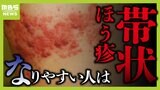 【耐えられない痛み】増加する『帯状ほう疹』若い世代も要注意！合併症で結膜炎や顔面神経麻痺などのおそれも　どんな人が発症しやすい？|TBS NEWS DIG