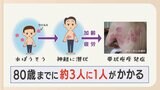 「帯状疱疹」に注意 4月から65歳以上にワクチン定期接種スタート 50代から急増 女性の割合が高いというデータも|TBS NEWS DIG
