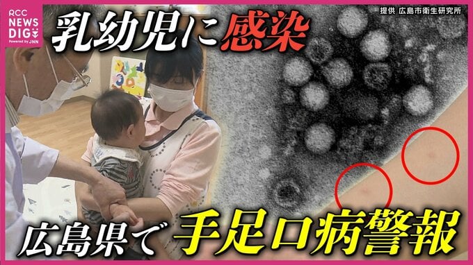 「手足口病」感染拡大　症状や感染経路 予防方法は　小児科医「まずは規則正しい生活を」　|　RCC NEWS | 広島ニュース | RCC中国放送