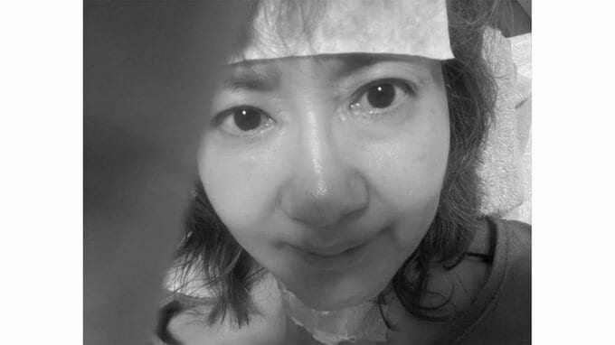 【がん闘病】古村比呂さん　帯状疱疹「頭皮に出来た水ぶくれがかさぶたになりにくく滲出液のようにジクジクとまだ滲み出ています」|TBS NEWS DIG