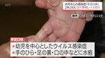 幼児を中心とした感染症「手足口病」　宮崎県内で急増　2年ぶりに流行警報レベルを超える|TBS NEWS DIG
