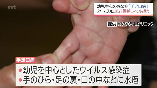 幼児を中心とした感染症「手足口病」　宮崎県内で急増　2年ぶりに流行警報レベルを超える|TBS NEWS DIG