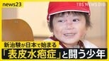 全身に水疱ができる皮膚の難病「表皮水疱症」と闘う男の子　最新の治療薬の治験が日本で始まる【news23】|TBS NEWS DIG